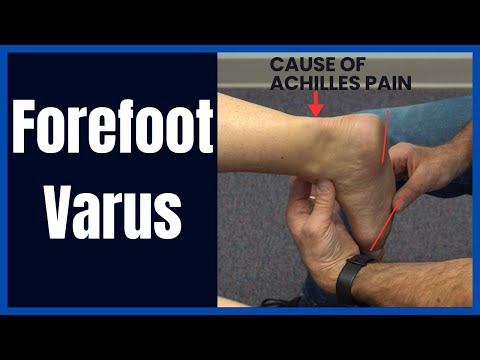 Metatarsalgia and Morton s Neuroma Evaluation and Treatment