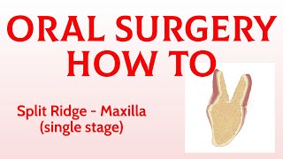 Oral Surgery How To: Split Ridge technique in maxilla (single stage)