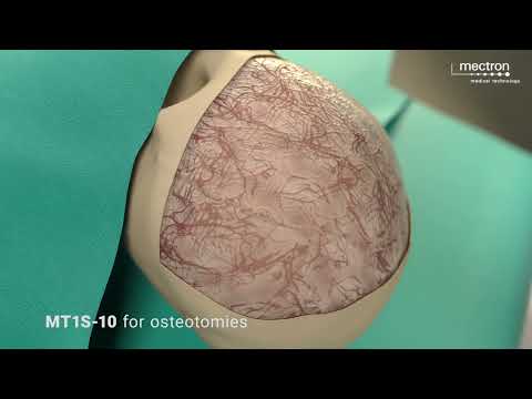 PIEZOSURGERY® | Neuropediatric Surgery - Cranioplasty and reshaping of frontorbital bandeau