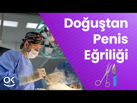 Doğuştan Penis Eğriliği