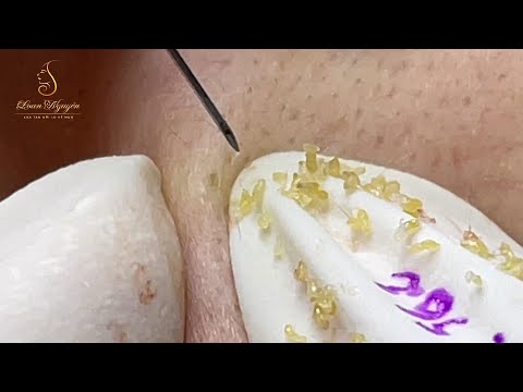 Loan Nguyen Acne Treatment (#113)