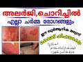 Quranic solution for skin diseases | അലർജി മാറാൻ| ചർമ്മ രോഗങ്ങൾ മാറാ