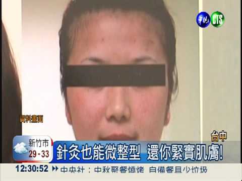 針灸也能微整型 還你緊實肌膚!