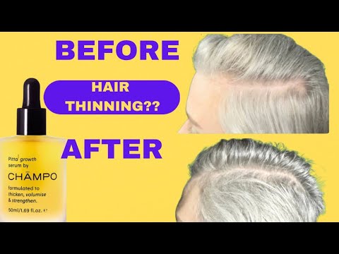 Does CHAMPO Pitta Growth Serum Really Work? 12 Week Review