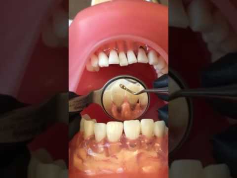 Professor Norrell: Use of Nevi 1 Anterior Scaler