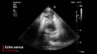 Massive clot in the apex of the left ventricle causes a stroke Echocrdiography Thrombus in the heart