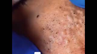 10 MINUTES OF THE BEST PIMPLE POPS! | PART 1
