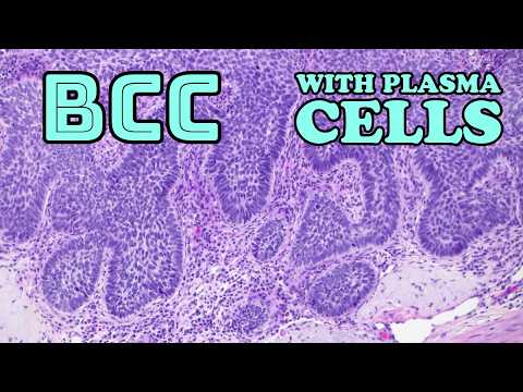 Basal cell carcinoma under microscope (BCC with TONS of plasma cells!) skin cancer pathology