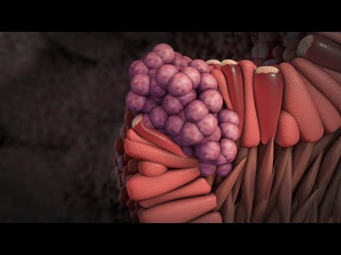 Types of Esophageal Cancer: Squamous Cell Carcinoma vs. Adenocarcinoma