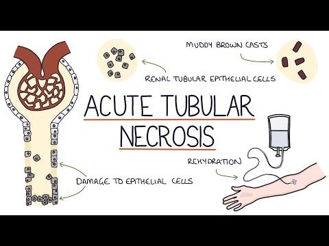 Understanding Acute Tubular Necrosis