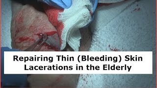 Repairing Thin (Bleeding) Skin Lacerations of the Elderly