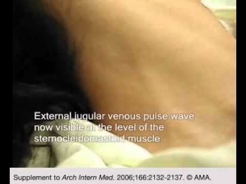 Usefulness of the External Jugular Vein Examination in Detecting Abnormal Central Venous Pressure in