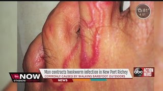 Tampa Bay area mam contracts hookworms