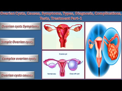 Ovarian Cysts, Causes, Symptoms, Types, Diagnosis, Complications, Tests, Treatment Part 1