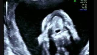 Labio Leporino - Hendidura palatina. Diagnostico Prenatal.