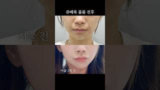 팔자주름 쫙 핀 쥬베룩 전후