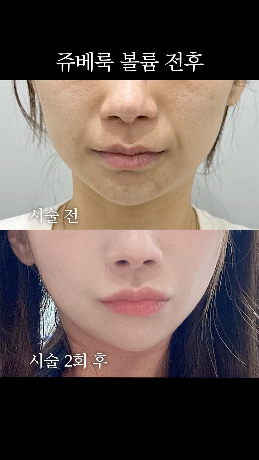 팔자주름 쫙 핀 쥬베룩 전후