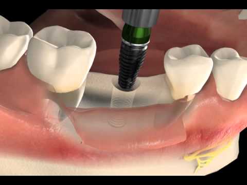 Dental Implant Surgery 1- implantindia.com