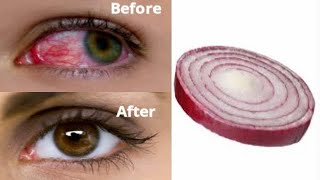 Onion in 5 days improve bad eyesight  remove bad eyesight redness of eyes