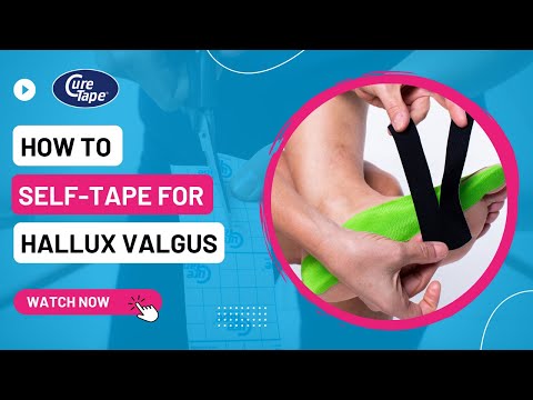 How to Tape a Bunion (Hallux Valgus) » Kinesiology Taping Instructions » CureTape