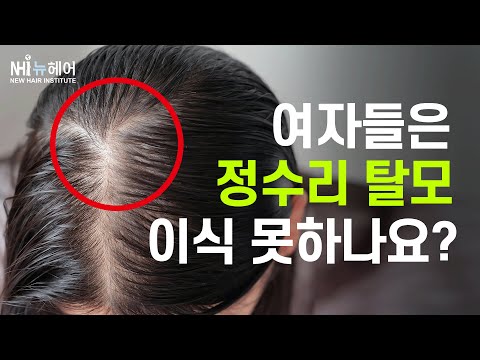 여자 정수리 탈모에는 모발이식 못 한다고..?│뉴헤어