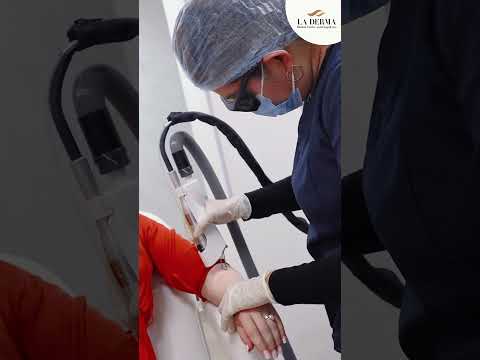 Laser hair removal | best result | best laser hair...