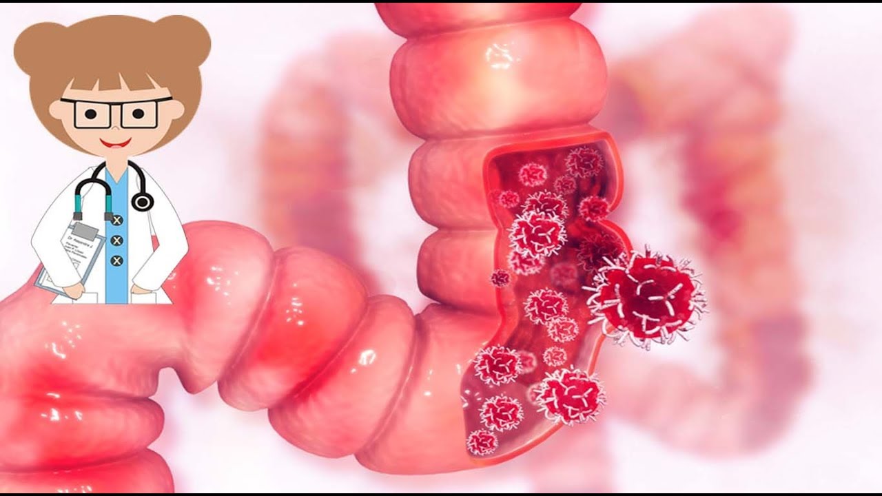 Sympto?mes du cancer du co?lon: ne jamais ignorer ces 6 signes