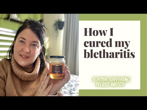 How I cured my BLEPHARITIS / chronic eye condition