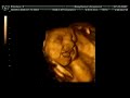 Ultrasound of Baby Yawning