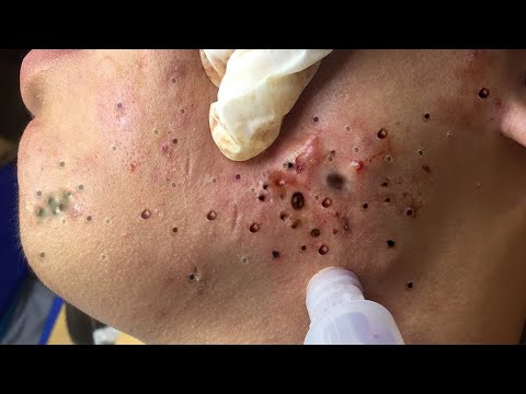 Deep Pore Blackhead Removal – Satisfying Acne Extraction & Relaxing Skincare - 234991
