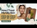 Acne Treatment For Oily Skin Complete Beginner Skincare Guide