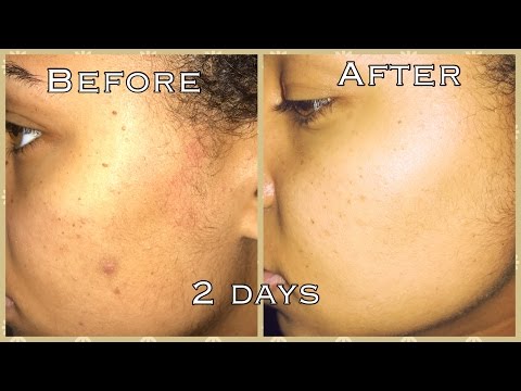 How To GET RID OF ACNE & DARK SPOTS in Days Video