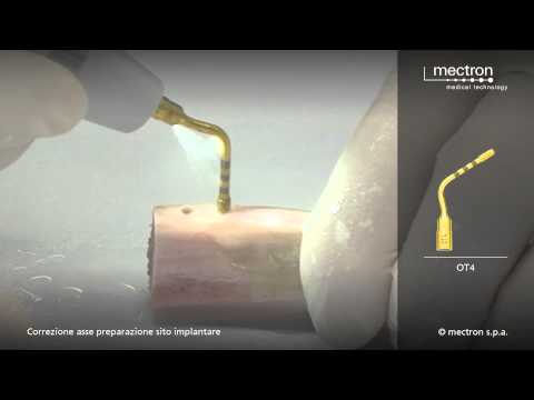 PIEZOSURGERY - HANDS-ON - Correction of the implant axis