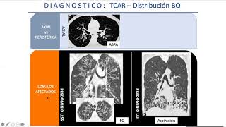 Bronquiectasias (Dra. Ana Inés Gruss) - Módulo Respiratorio