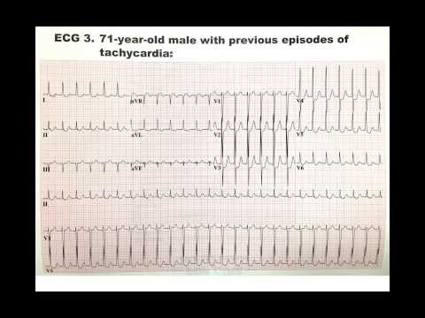 abbahagyta a dohányzást tachycardia elmúlt