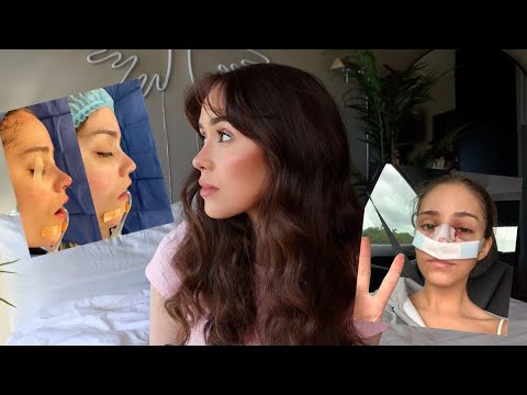 i had two nose jobs... let's talk about it *part 2* (EXPERIENCE, PHOTOS, Q&A)
