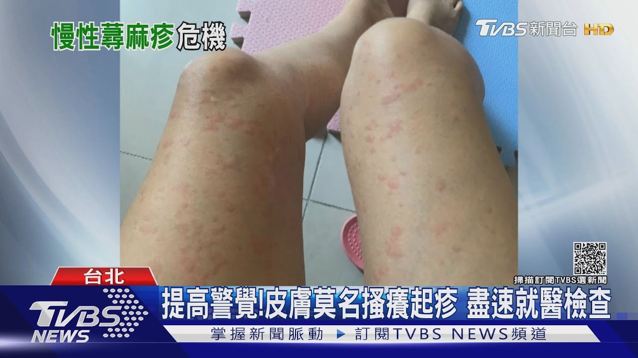 皮膚搔癢難耐抓到破皮蕁麻疹找上門 醫師警告:注意這件事