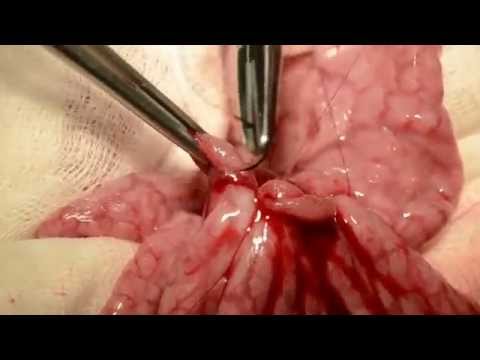 Entero-Entero Anastomosis Side to Side - YouTube