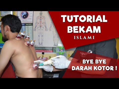 download lagu mp3 mp4 Tutorial Bekam Sunnah, download lagu Tutorial Bekam Sunnah gratis, unduh video klip Tutorial Bekam Sunnah