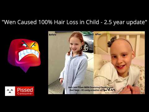 Wen Caused 100% Hair Loss in Child - 2.5 year update