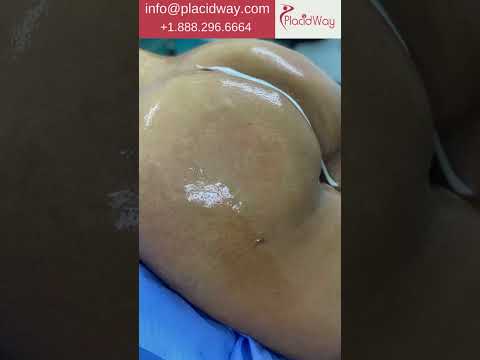 Liposuction in Dominican Republic by El Vergel Clinic
