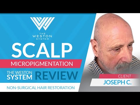 Joseph C.'s Transformation Tale: Weston System's Premier Scalp Micropigmentation Experience