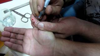 Как вытащить рыболовный крючок из пальца