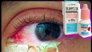 Download lagu Penyakit Konjungtivitis bakteri dan Salep Mata Chloramphenicol untuk pengobatannya mp3 Download lagu Penyakit Konjungtivitis bakteri dan Salep Mata Chloramphenicol untuk pengobatannya mp3