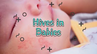 Baby Hives , allergies and skin rash