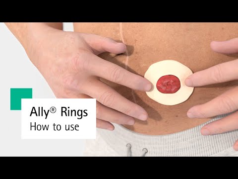 Ally® Rings – Ostomy Ring How to Use