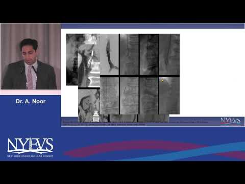 Who should get IVC filter retrieval an evidence based apporach Amir Noor Session IV Inferior vena ca