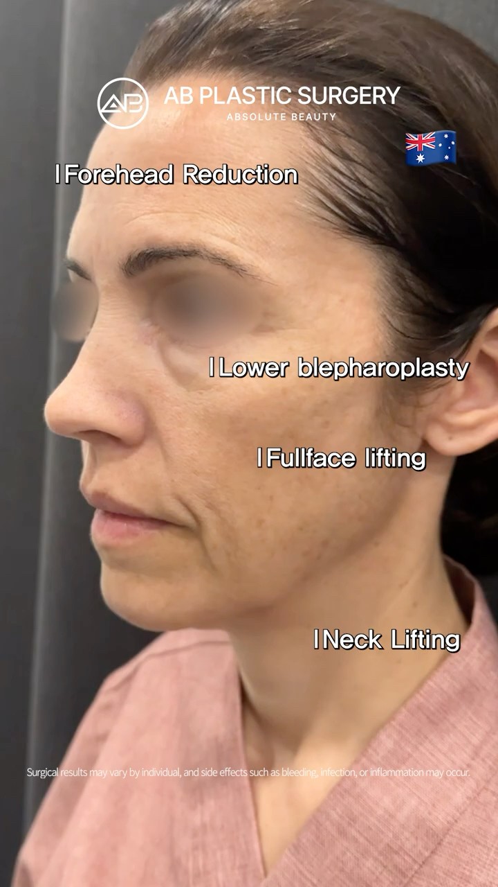Forehead Reduction + Lower Blepharoplasty + Facelift Results ✨