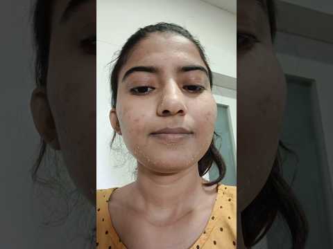 Chemical Peeling Acne Treatment 😍 Chemical peel Result | #skincare #shorts