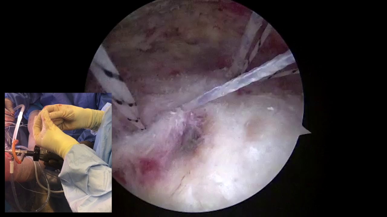 Dr. Garcia demonstrates his innovated technique for partially torn, articular sided rotato...